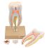 Eisco® 6 Part Upper Trip Root Molar