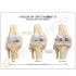 GPI Anatomicals® Stages of Osteoarthritis Knee Model