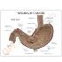 GPI Anatomicals® Stomach Cancer