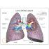 GPI Anatomicals® Lung Set with Pathologies